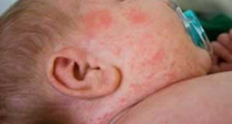  چگونه پوست عرق سوز شده را درمان کنیم؟ 