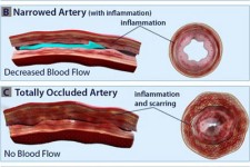  علل و انواع بیماری واسکولیت 