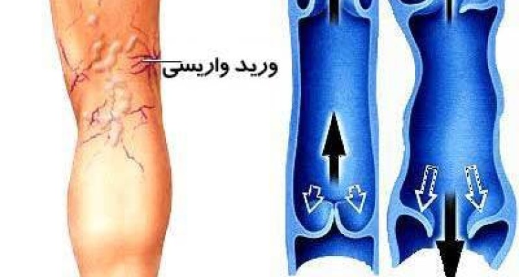 لباس تنگ و کفش پاشنه بلند یکی از علل بروز واریس در زنان