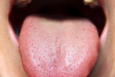  التهاب زبان (گلوسیت)؛ علل، نشانه ها و درمان بیماری التهاب زبان 