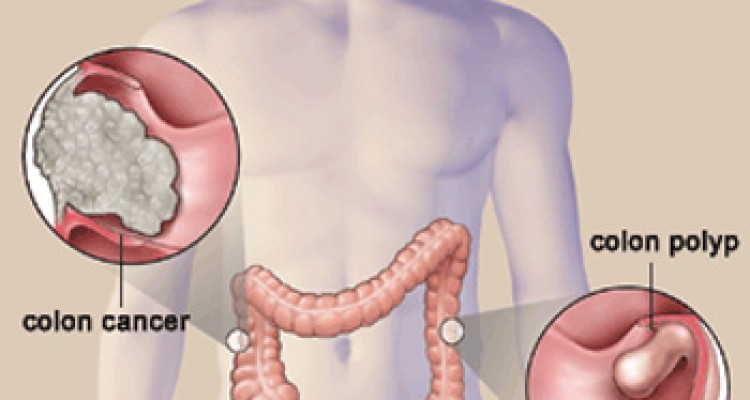  5 راه ساده برای پیشگیری از سرطان روده بزرگ 
