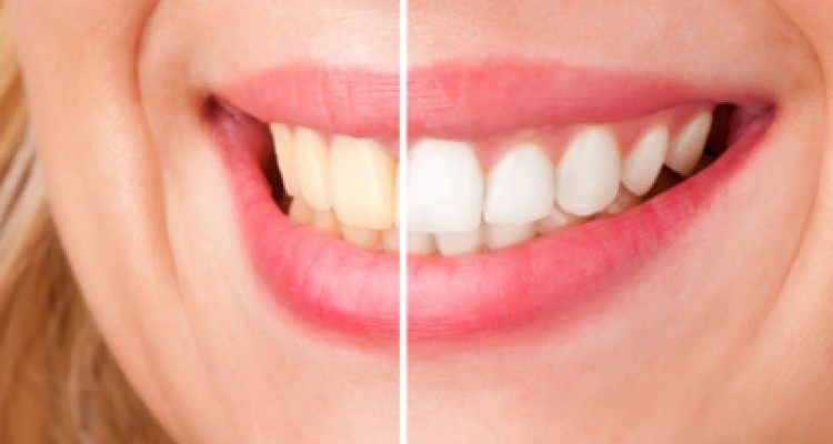  جرم گرفتن دندان به دلیل 7 خطا 