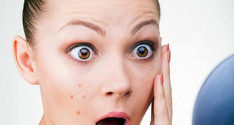 بیش از ۹۰ درصد جوش‌های صورت "عصبی" نیستند