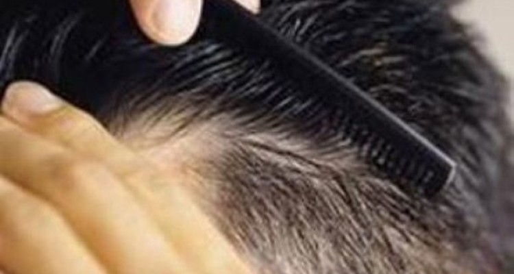 ژنتیک عامل ریزش مو در مردان
