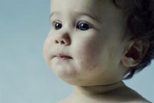  اگزمای کودکان 