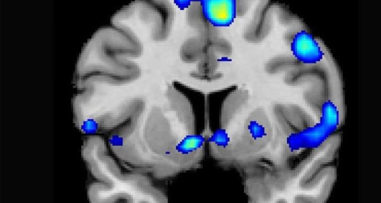 تشخیص محل HIV در مغز با اسکن MRI