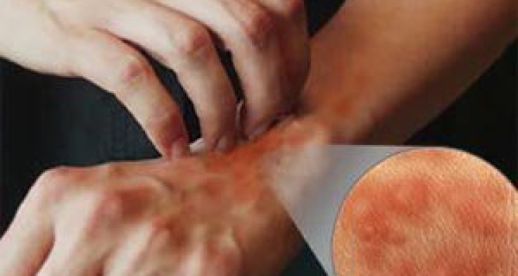  خارش شدید پوست هنگام شب از علائم بیماری گال است