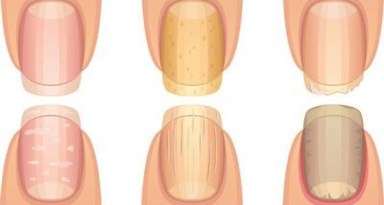  فهمیدن بیماری ها از روی علامت ناخن ها