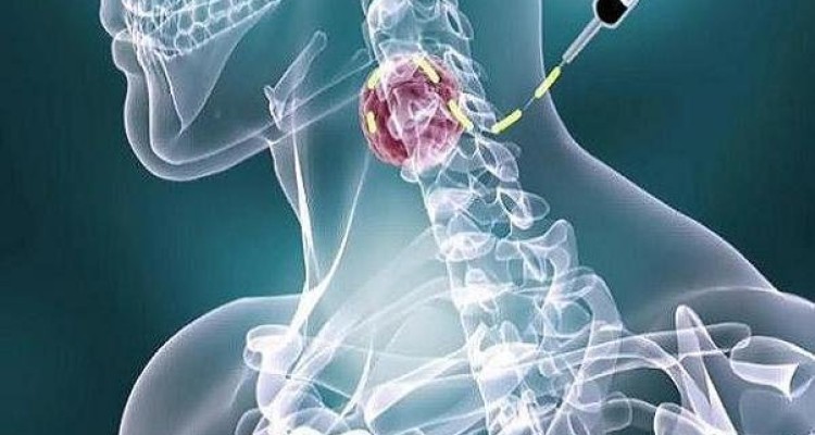 ارتباط اختلالات روانپزشکی در بروز سرطان