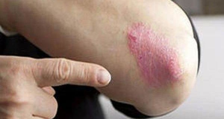 ۴ علامت اصلی تبدیل خال به سرطان/ویژگی کرم‌های ضدآفتاب 