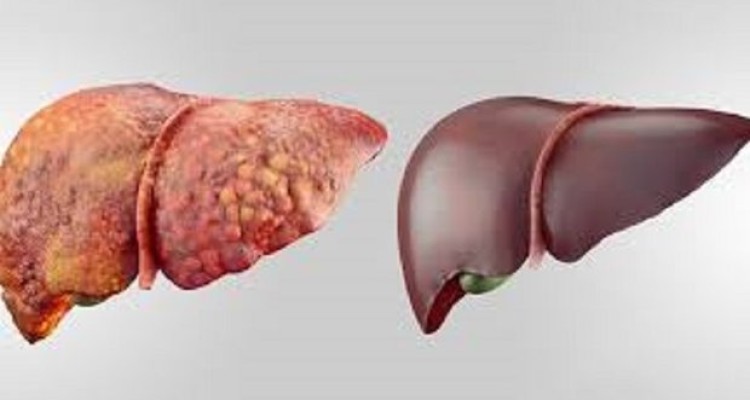 علل بروز کبد چرب/مراقب چربی خون و چاقی باشیم