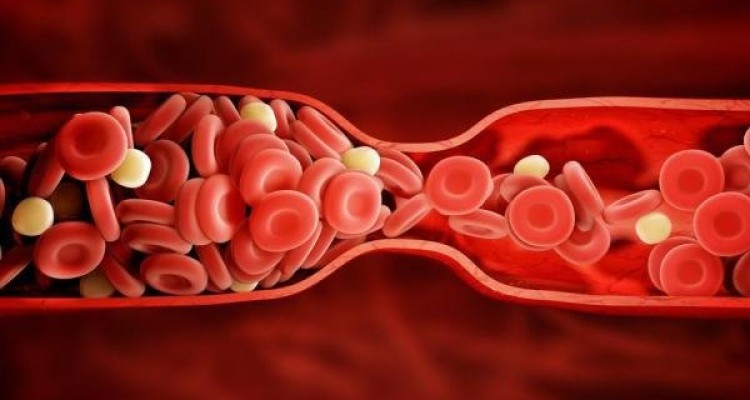 سندروم متابولیک موجب بروز مجدد لختگی خون می شود