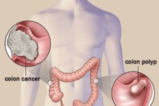 5 راه ساده برای پیشگیری از سرطان روده بزرگ 