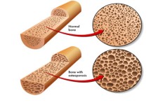  خوردنی های مضر برای استخوان ها 