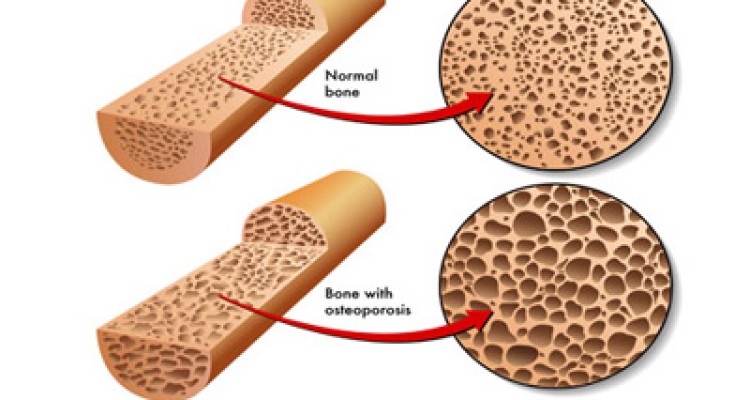  خوردنی های مضر برای استخوان ها 