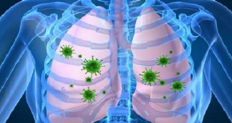 افزایش خطر انسداد مزمن ریوی در مبتلایان به HIV