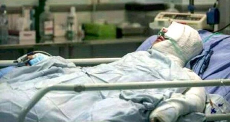 احتمال ابتلا به کرونا در افراد دچار سوختگی بیشتر است