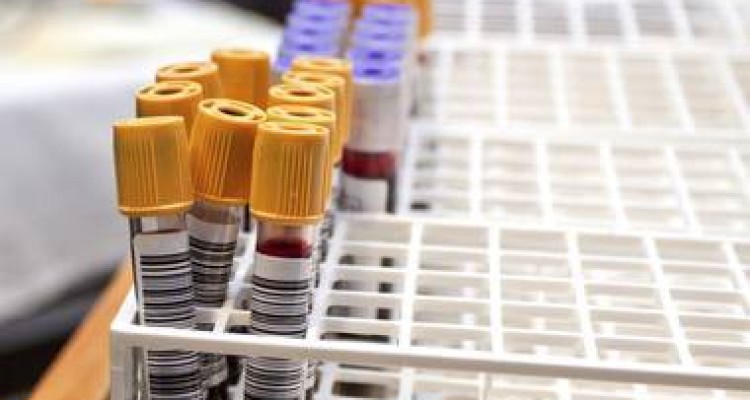  کدام گروه‌های خونی بیشتر به کرونا مبتلا می‌شوند؟