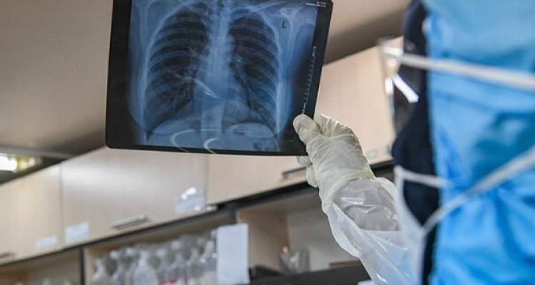  مشکلات تنفسی در بهبود یافتگان کووید- ۱۹ ماندگار است؟