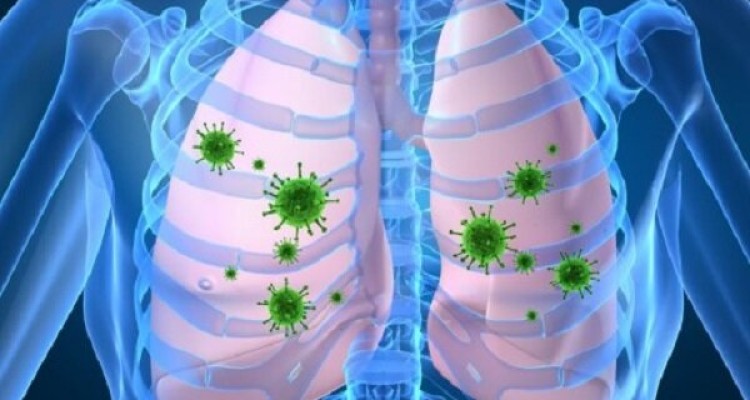 تاثیر داروی پوکی استخوان در مقابله با ذات الریه