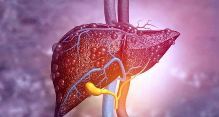  ارتباط بین اختلال در عملکرد کبد و تاثیر آن بر قلب