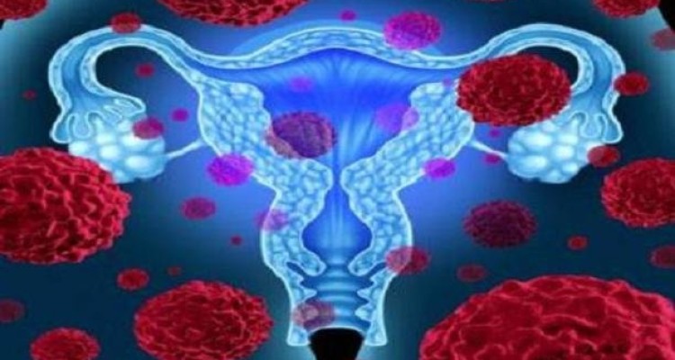 ارتباط داروی استاتین با کاهش مرگ ناشی از سرطان تخمدان