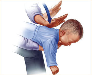  علل و روش های پیشگیری از خفگی 