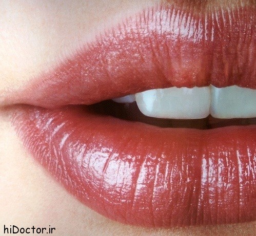 جراحی پروتز لب + مزایا و معایب پروتز لب جراحی پروتز لب + مزایا و معایب پروتز لب