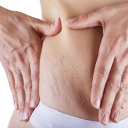  استرچ مارک یا ترک های پوستی و راههای پیشگیری و درمان آن 