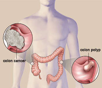  5 راه ساده برای پیشگیری از سرطان روده بزرگ 