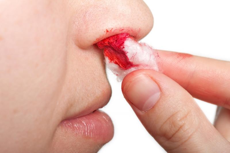  چگونه خونریزی بینی را متوقف کنیم 