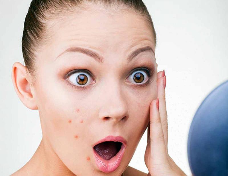 بیش از ۹۰ درصد جوش‌های صورت "عصبی" نیستند