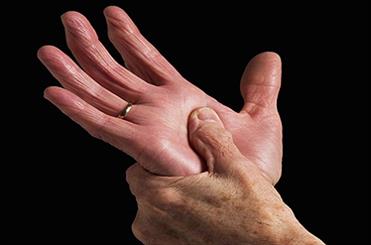 ارتباط یک نوع میکروب با بیماری لثه و آرتروز روماتوئید