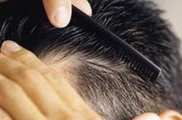 ژنتیک عامل ریزش مو در مردان