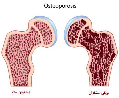  کمبود ویتامین D را جدی بگیرید