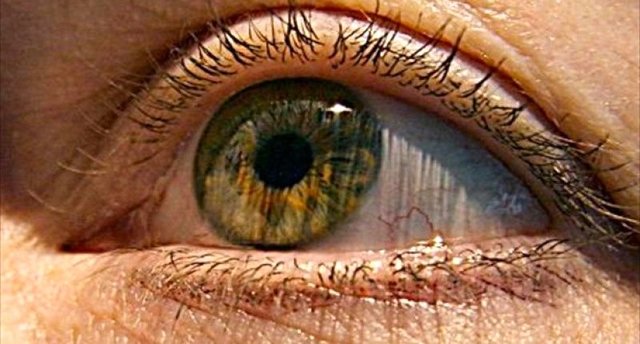  ارتباط ضعف بینایی با زوال ذهنی