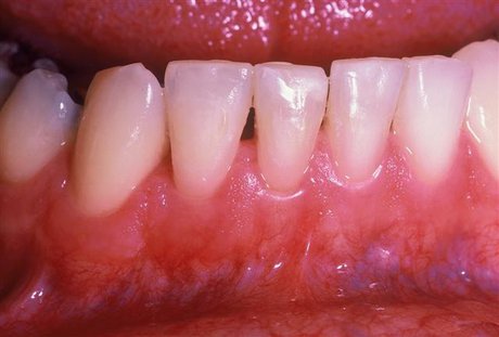  خطرات غیرمنتظره بیماری لثه