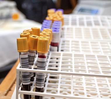  کدام گروه‌های خونی بیشتر به کرونا مبتلا می‌شوند؟