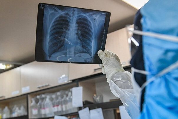  مشکلات تنفسی در بهبود یافتگان کووید- ۱۹ ماندگار است؟