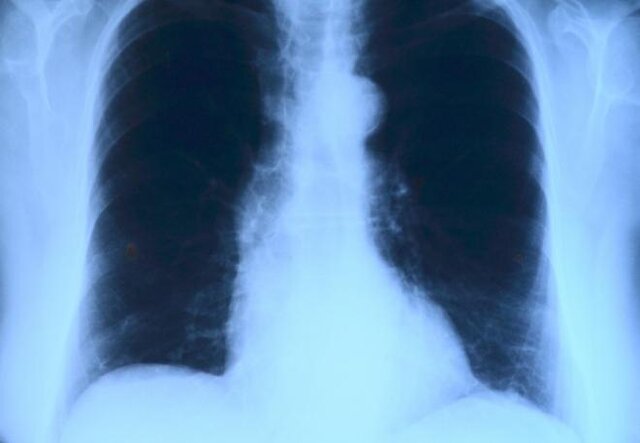  نشانه‌های هشداردهنده بیماری ریوی